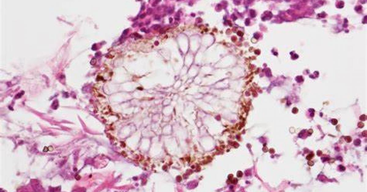 ব্লেক, হোৱাইট আৰু য়েলো ফাংগাছৰ পাছত এইবাৰ আতংক এছপাৰগিলোছিছৰ