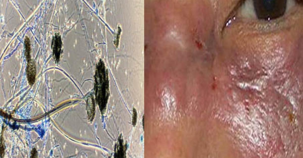 ক’ভিডতকৈও প্রাণঘাতী মাক’ৰমাইক’ছিছ 