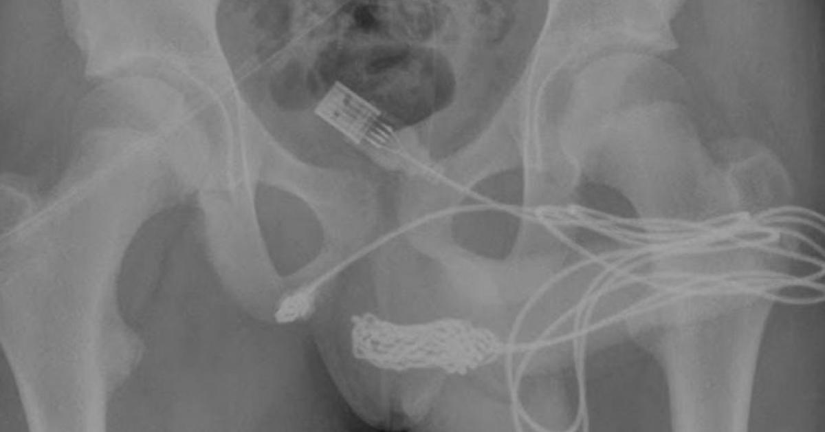 Teenager inserts USB Cable into urethra to measure genitals