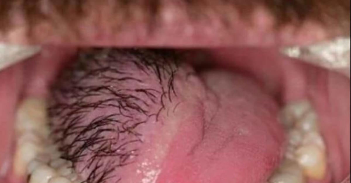 Tongue Hair
