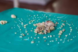 ২৩২ টা দাঁত এজন যুৱকৰ