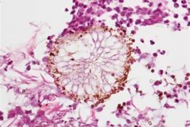 ব্লেক, হোৱাইট আৰু য়েলো ফাংগাছৰ পাছত এইবাৰ আতংক এছপাৰগিলোছিছৰ