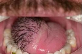 Tongue Hair